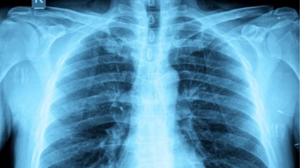 Καρκίνος: Οι παχύσαρκοι που κάνουν ακτινογραφίες κινδυνεύουν περισσότερο